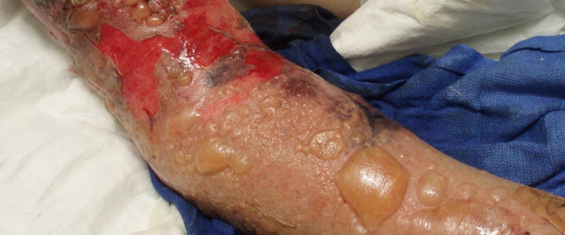 Understanding Necrotizing Fasciitis and Hyperbaric Oxygen Therapy