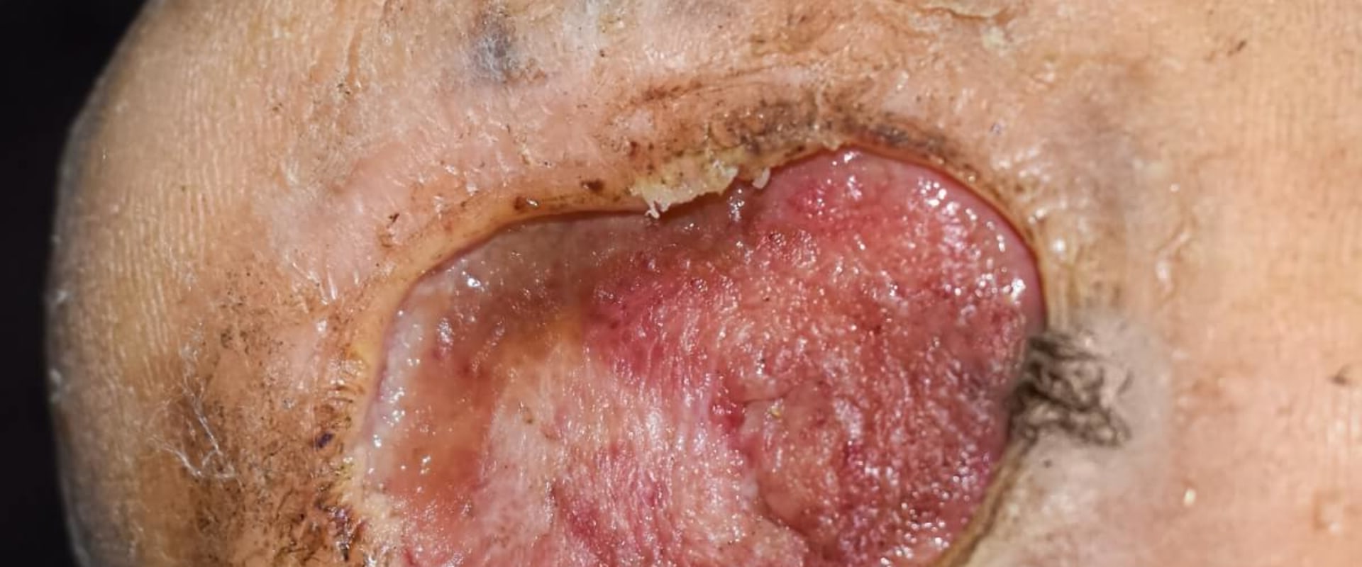 Understanding Diabetic Foot Ulcers: A Comprehensive Guide to Hyperbaric Chamber Therapy