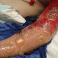 Understanding Necrotizing Fasciitis and Hyperbaric Oxygen Therapy