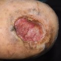 Understanding Diabetic Foot Ulcers: A Comprehensive Guide to Hyperbaric Chamber Therapy
