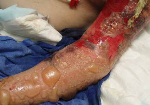 Understanding Necrotizing Fasciitis and Hyperbaric Oxygen Therapy