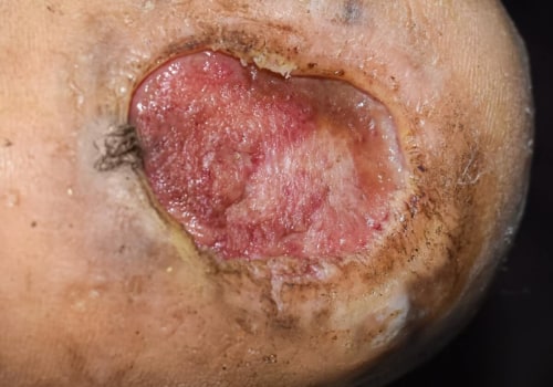 Understanding Diabetic Foot Ulcers: A Comprehensive Guide to Hyperbaric Chamber Therapy
